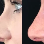 Nose Job in Dubai – Cost Factors and Considerations