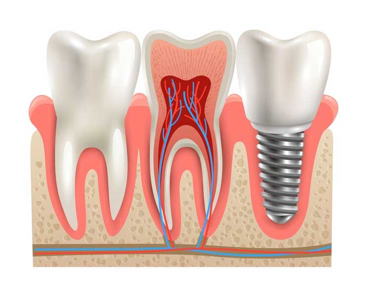 Dental Implant Dubai: Complete Guide to Procedures and Costs