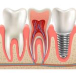 Dental Implants Dubai Explained for Long-Term Tooth Solutions