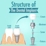 Tooth Implant Cost in Dubai and the Factors That Matter