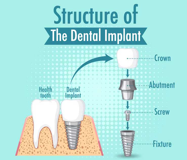 Tooth Implant Cost in Dubai and the Factors That Matter