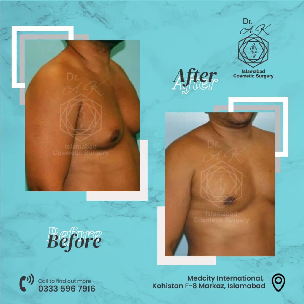 gynecomastia in islamabad
