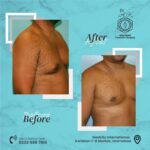 gynecomastia in islamabad