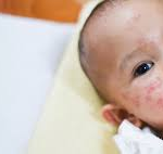 A Comprehensive Look at pediatric dermatologist in Dubai Services for Children’s Skin Health