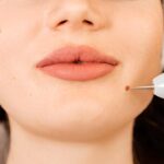 wart removal in Islamabad