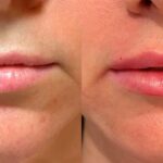lip augmentation in Islamabad
