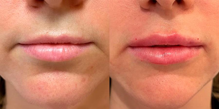 lip augmentation in Islamabad