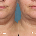 عملية تصغير الذقن في الرياض