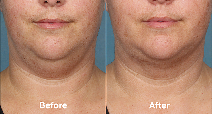 عملية تصغير الذقن في الرياض