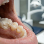 Is a Temporary Dental Filling Safe for Daily Use?