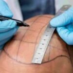 Hair Transplant in Riyadh