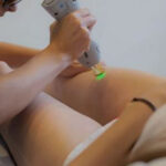 إزالة الشعر بالليزر في دبي