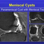 Meniscal Cyst