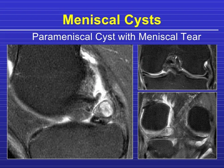 Meniscal Cyst