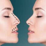 تجميل الأنف في دبي