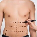 Tummy Tuck in Islamabad