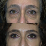 Eye Bag Removal in Dubai