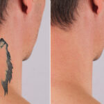 laser tattoo removal