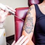 laser tattoo removal in islamabad