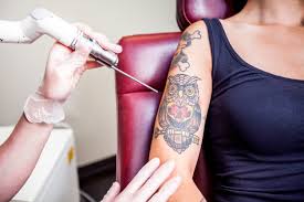 laser tattoo removal in islamabad