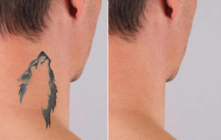 laser tattoo removal
