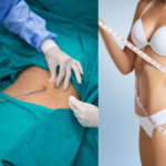 شفط الدهون في الرياض