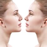 rhinoplasty in islamabad