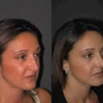 تجميل الأنف في دبي