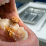 What to Avoid With a Temporary Dental Filling?
