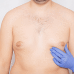 Gynecomastia In Islamabad