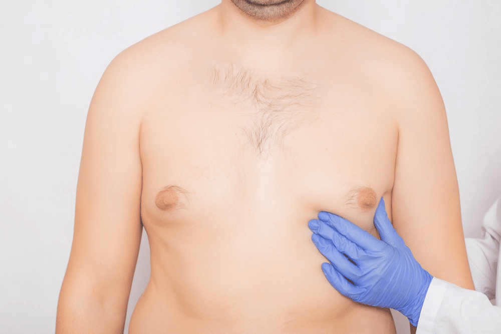 Gynecomastia In Islamabad