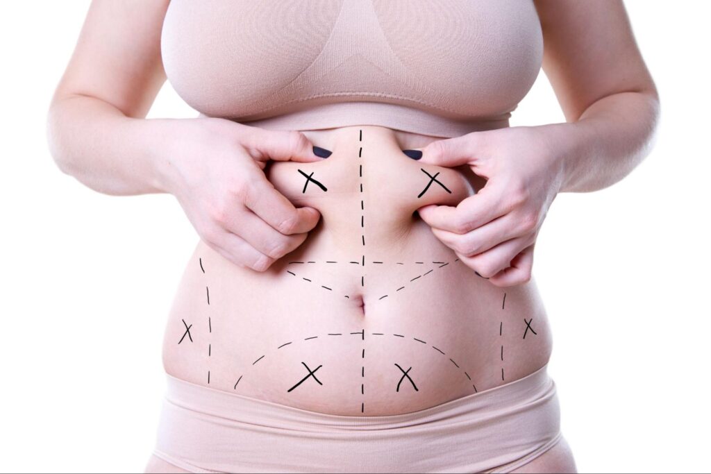 Liposuction in Islamabad 3