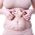 Liposuction in Islamabad 3