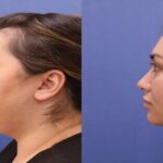 chin lipo treatment in islamabad