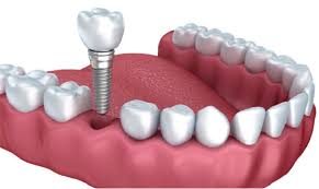 Life After Dental Implants: What You Should Expect