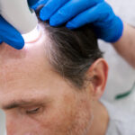 Scalp fungus: Itching and hair loss problems that shouldn’t be ignored.