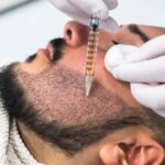 زراعة شعر اللحية في دبي