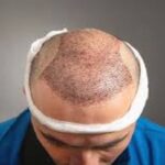 زراعة الشعر في دبي