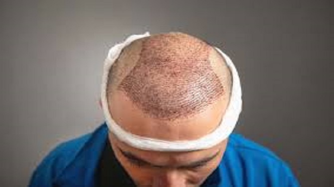 زراعة الشعر في دبي