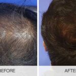 نتائج زراعة الشعر قبل وبعد