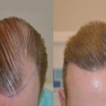 تكلفة زراعة الشعر في دبي