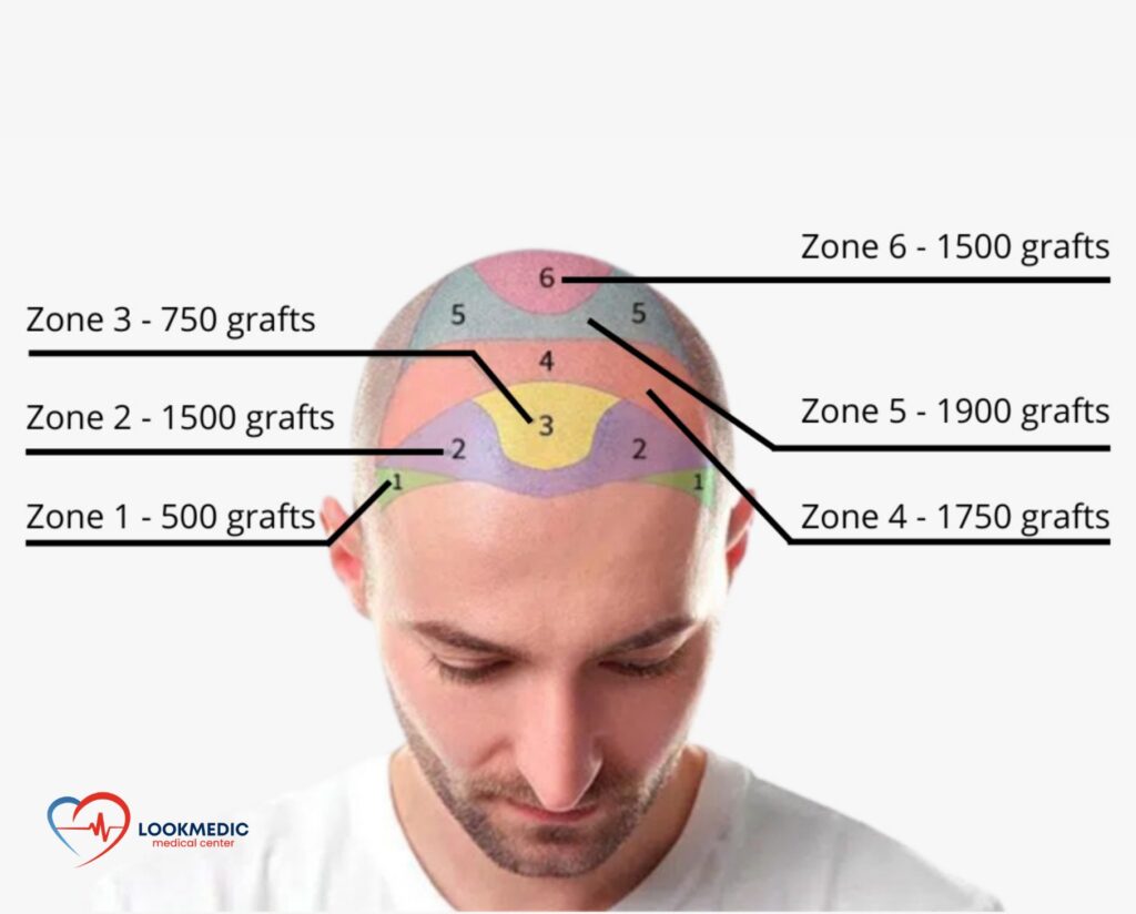 Best Hair Transplant Turkey: How to Choose Between Local Anesthesia and Sedation