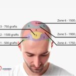 Best Hair Transplant Turkey: How to Choose Between Local Anesthesia and Sedation