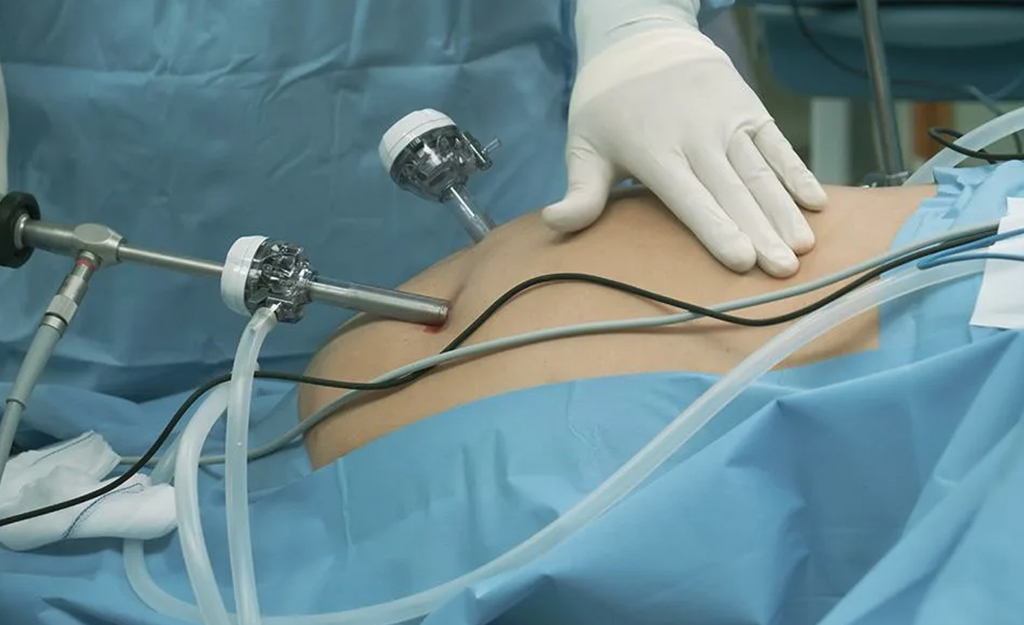 Laparoscopic surgery
