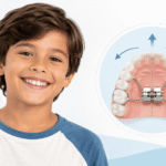 What Are Palate Expanders and When Are They Recommended for Children