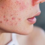 Best Acne Treatment In Dubai for Oily and Sensitive Skin Types