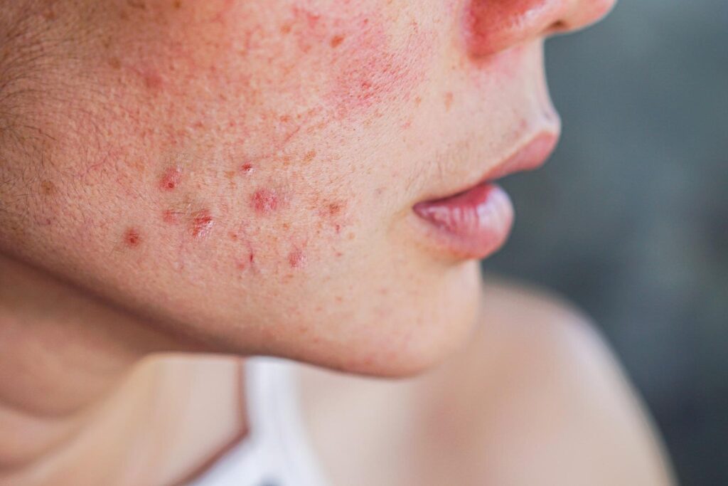 Best Acne Treatment In Dubai for Oily and Sensitive Skin Types