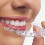Benefits of Choosing Aligners In Dubai for Teeth Straightening