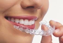 Benefits of Choosing Aligners In Dubai for Teeth Straightening