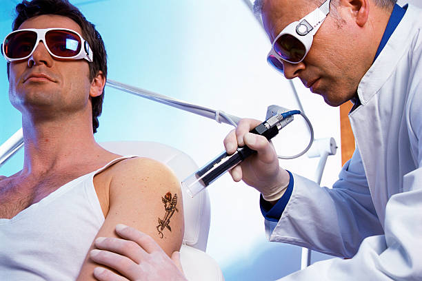 laser tattoo removal in Dubai